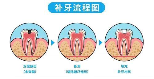 补牙的流程
