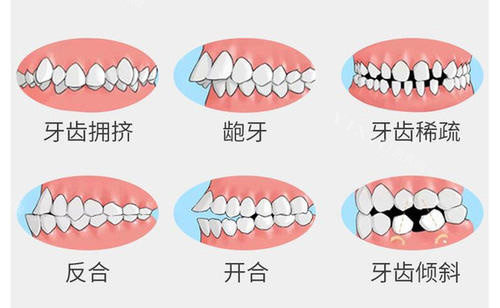 矫正牙齿畸形示意图