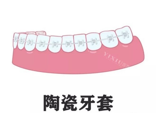 陶瓷牙套示意图