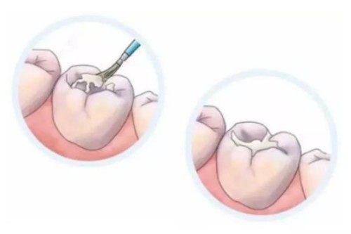 儿牙蛀牙预防卡通图