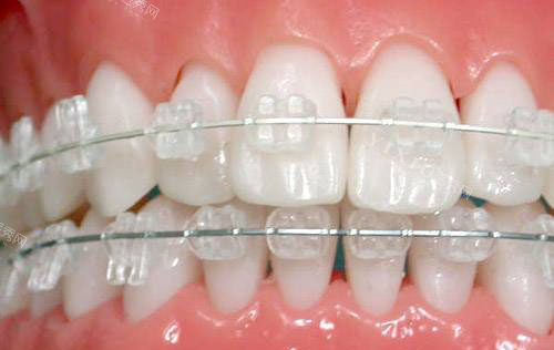 透明保持器会越戴越松吗，想知道保持器只晚上戴会反弹吗？(图4)