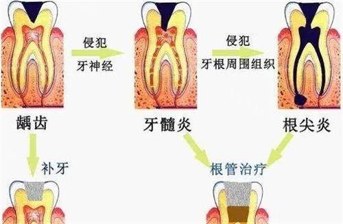 牙髓炎的治疗方法