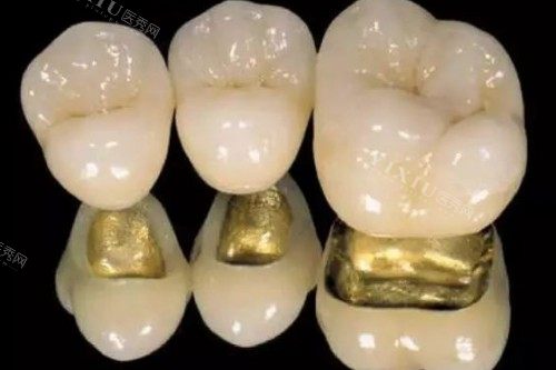 阿曼吉尔巴赫全瓷牙多少钱一颗？将品质特点+价格+优势+维护与保养也告知于您！(图3)