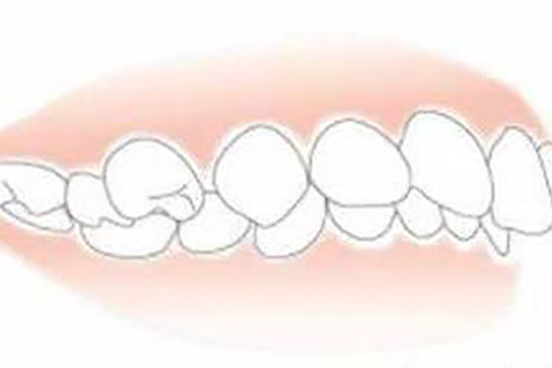 萌新必读：咬合重建与正畸的区别大揭秘，你选哪个？(图3)