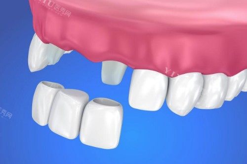 您不知道吧其实有良心的牙医并不推荐镶牙修复！下面为您解释清楚为什么不建议的原因！(图1)