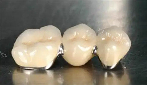 做全瓷牙基牙早晚会烂掉吗？说一说全瓷牙对基牙有影响及全瓷牙基牙烂掉的表现(图2)