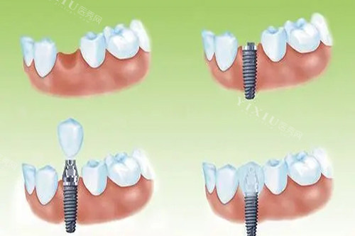单颗种植牙种植过程卡通示意图