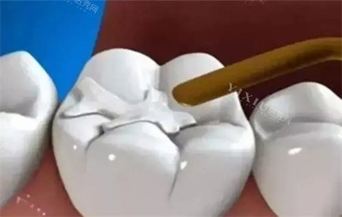 牙齿修复过程图