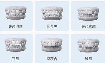 六种不同类型牙齿矫正适应症