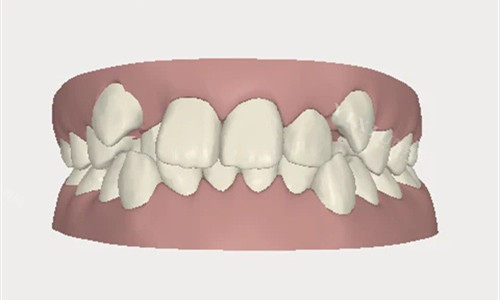 正畸如何把上牙压回去？别慌，正畸医生告诉你上牙包住下牙怎么矫正？(图1)
