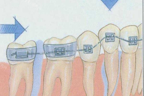 正畸如何把上牙压回去？别慌，正畸医生告诉你上牙包住下牙怎么矫正？(图2)