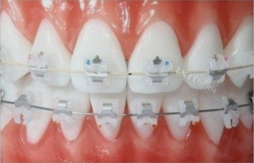 正畸如何把上牙压回去？别慌，正畸医生告诉你上牙包住下牙怎么矫正？(图4)