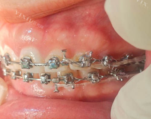 正畸如何把上牙压回去？别慌，正畸医生告诉你上牙包住下牙怎么矫正？(图6)