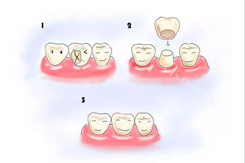 补牙手术的步骤