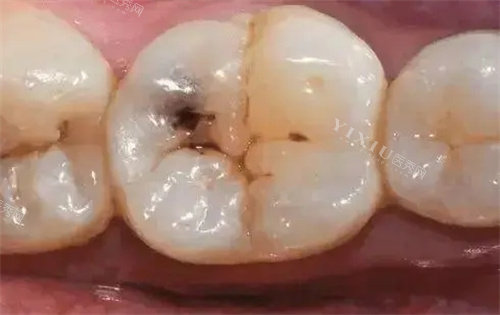 为什么医生不建议给儿童补牙？小孩子补牙的危害一定要悉知！(图1)