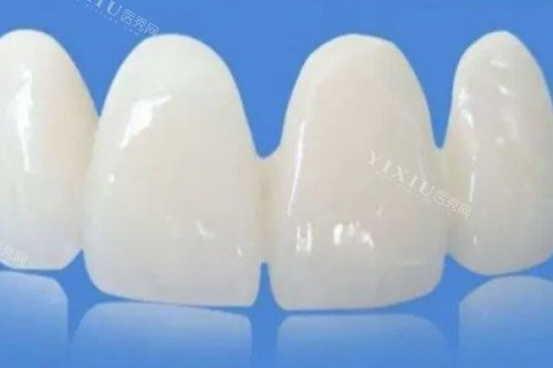 做了树脂贴面之后不想要了可以卸掉吗？卸掉会不会对本身的牙齿造成伤害？(图2)