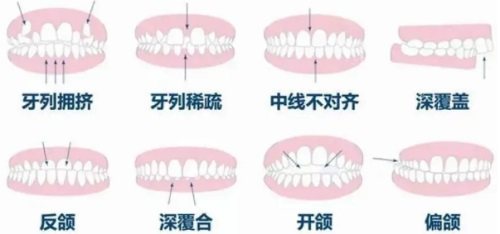 各种畸形牙齿示意图