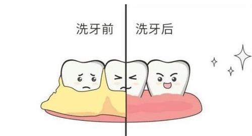 洗牙前后的对比
