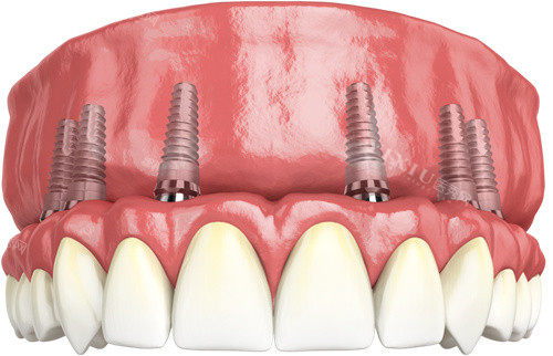 做半口牙6个植体需要