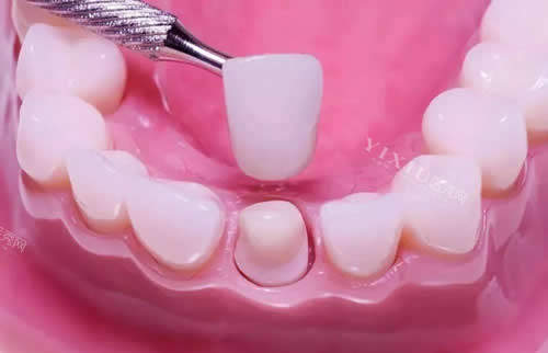 牙冠修复牙齿示意图
