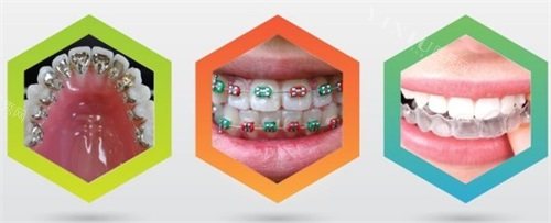 三种不同牙齿矫正牙套示意图