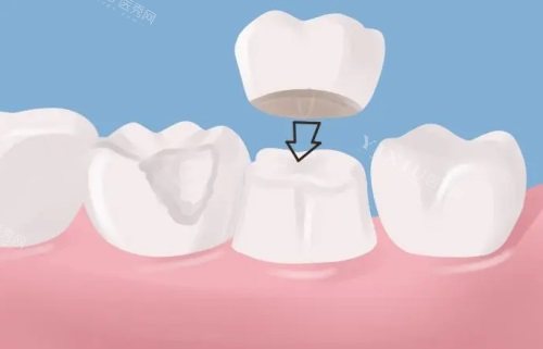 牙冠图片示意图