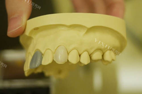 口腔医院牙贴面模型图片