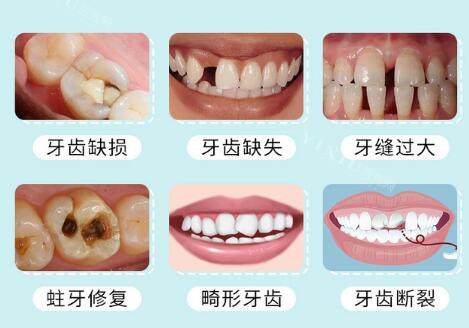 牙冠可以修复哪些牙齿类型
