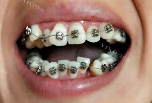 金属牙齿矫正过程图