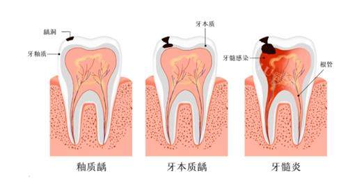 牙髓炎和其他牙齿炎症的对比