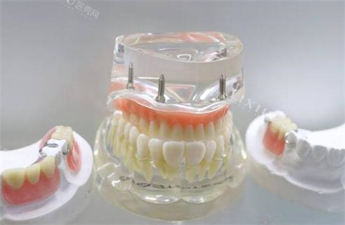 牙齿改善模型展示照片