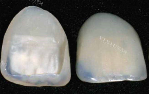 树脂贴面牙卸掉后和原来一样吗，成人牙缝隙大怎么修复比较好？