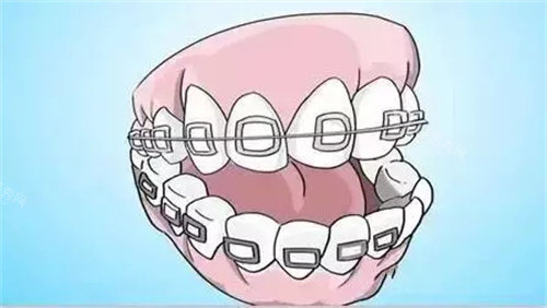 牙齿钢丝图