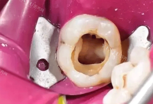 牙齿根管治疗图片