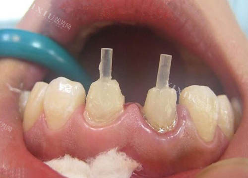 牙冠修复治疗图