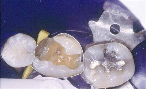 牙齿龋洞展示图