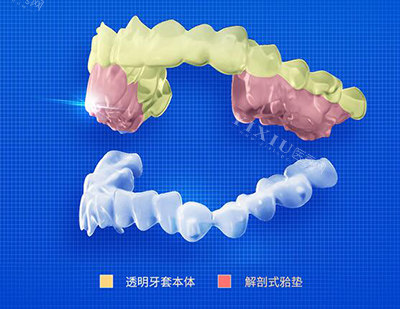 正雅牙套改善图展示照片