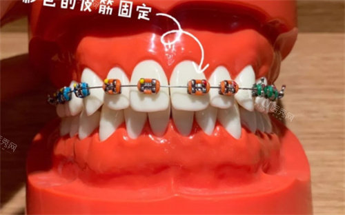 牙齿畸形模具图