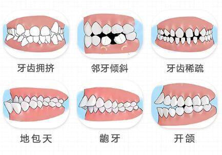 常见需要做正畸的牙齿类型
