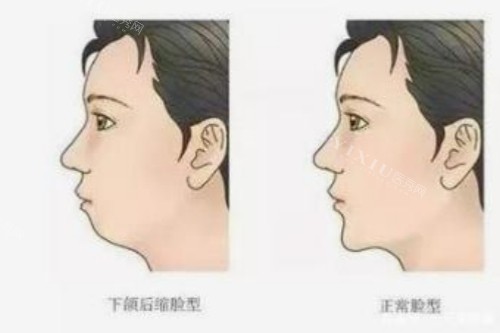 正常脸型和下巴后缩脸型对比图