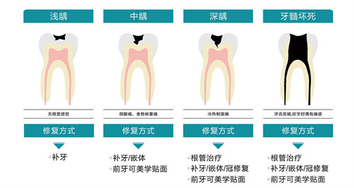不同龋齿的修复方式