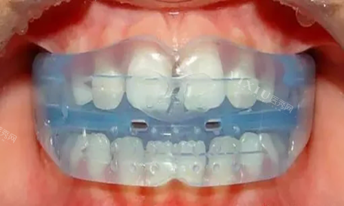 MRC儿童牙齿早期干预矫治器