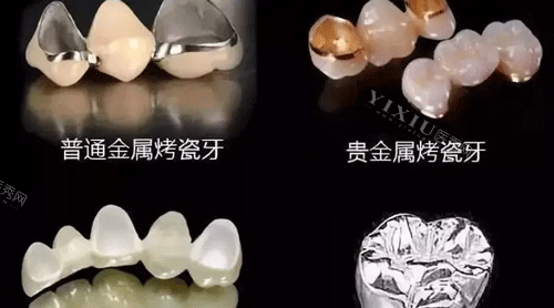 不同材质的牙冠照片