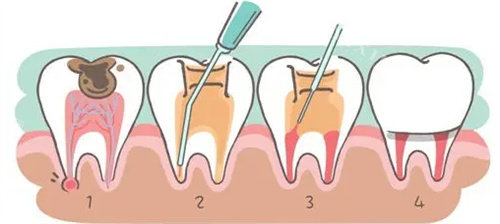 牙周治疗过程图