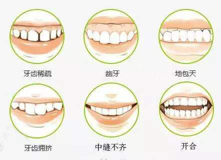 牙齿矫正不同的适应症