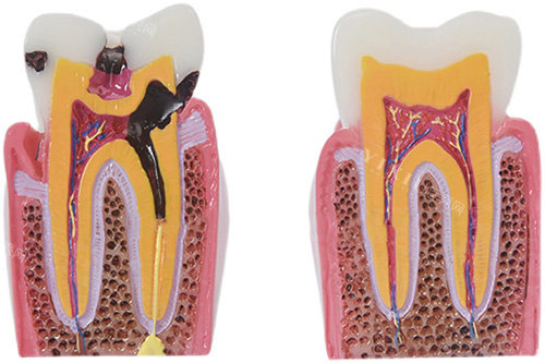 牙根龋坏模型图片