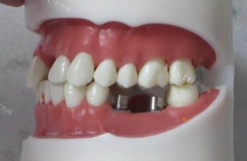 牙缺失植入植体图片展示
