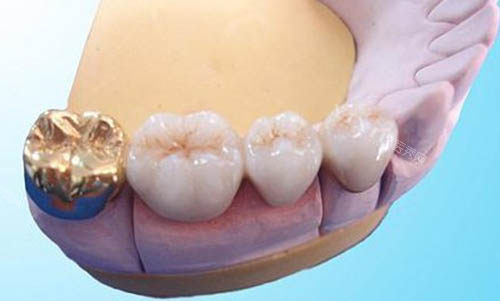 牙冠修复牙齿模型图片