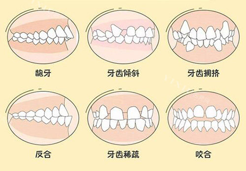 哪些情况牙齿要做正畸