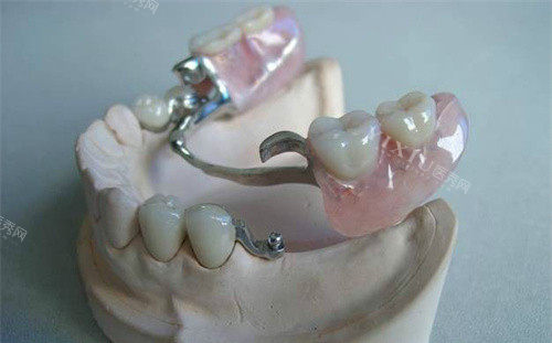 普通义齿和吸附义齿有啥区别？两者产品特点以及利弊分析一并介绍！(图1)